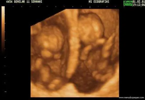 Ecografía de Gemelos de 9 Semanas | Vuestras Ecografías en 3D y 4D ... Ecografía de Gemelos de 9 Semanas | Vuestras Ecografías en 3D y 4D ...
