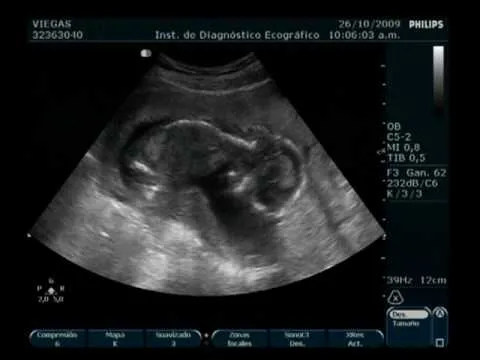 Ecografia Hostench Viegas 16 semanas VARON - YouTube Ecografia Hostench Viegas 16 semanas VARON - YouTube