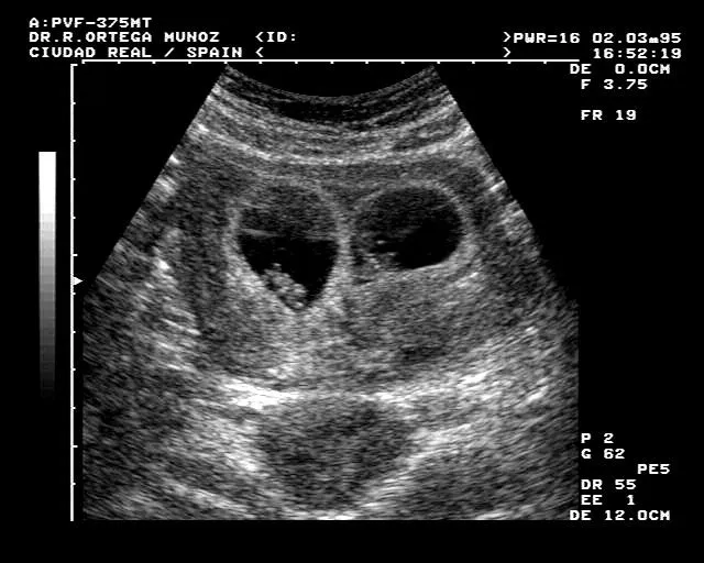 Embarazo mellizos 5 semanas ecografia - Imagui