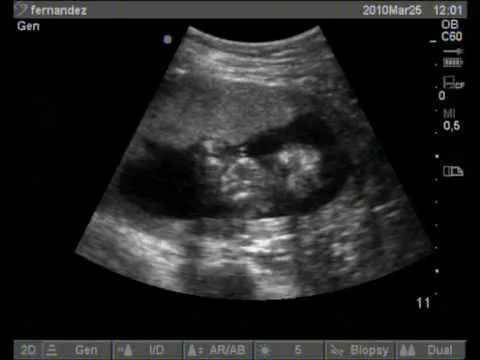 mi ecografia 4 meses -25/03/10 - YouTube