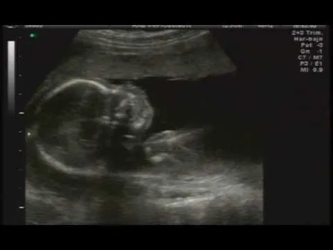 Ecografia de 4 meses.... son mujeres!!! - YouTube Ecografia de 4 meses.... son mujeres!!! - YouTube