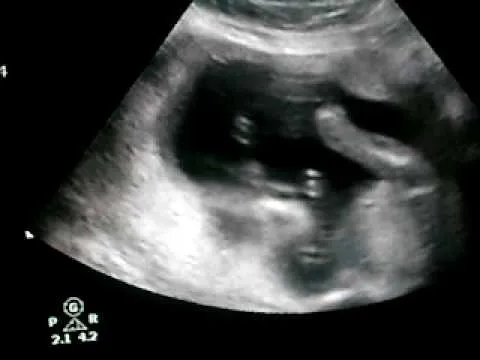 Ecografia de 4 meses.. - YouTube
