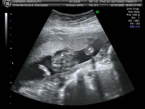 La ecografia de nuestra nena! Sarita! - YouTube