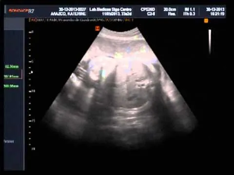 ecografia obstetrica 33 semanas de embarazo - YouTube