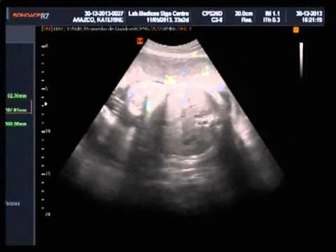 ecografia obstetrica 33 semanas de embarazo - YouTube ecografia obstetrica 33 semanas de embarazo - YouTube