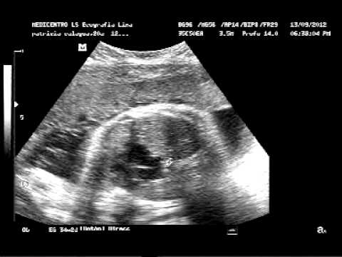 ECOGRAFIA OBSTETRICA DE PATTY A LAS 34 SEMANAS DE GESTACION - YouTube ECOGRAFIA OBSTETRICA DE PATTY A LAS 34 SEMANAS DE GESTACION - YouTube