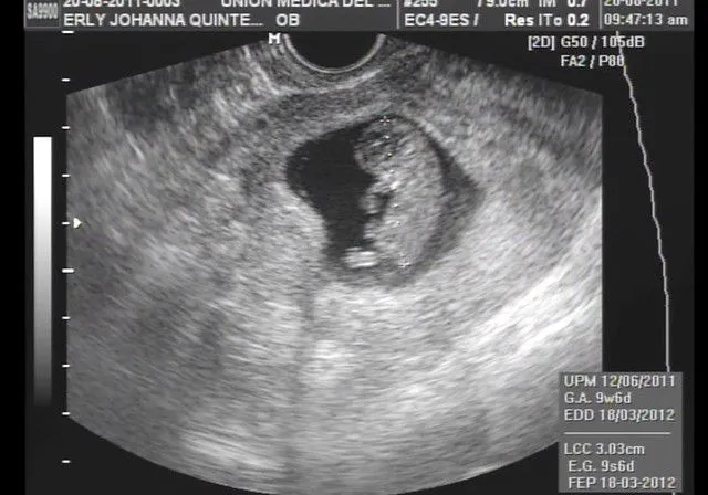 Imagenes de una ecografia de 8 semanas - Imagui Imagenes de una ecografia de 8 semanas - Imagui