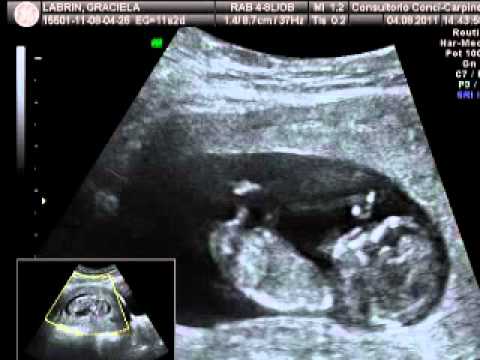 primera ecografia semana 11 - YouTube