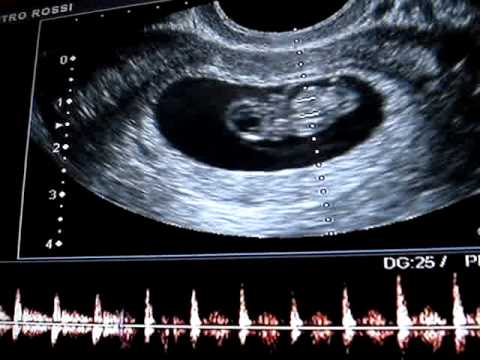 ecografia 1 semana 9 002 - YouTube