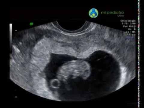 Ecografía 9 semanas de embarazo (7 de gestación) - YouTube