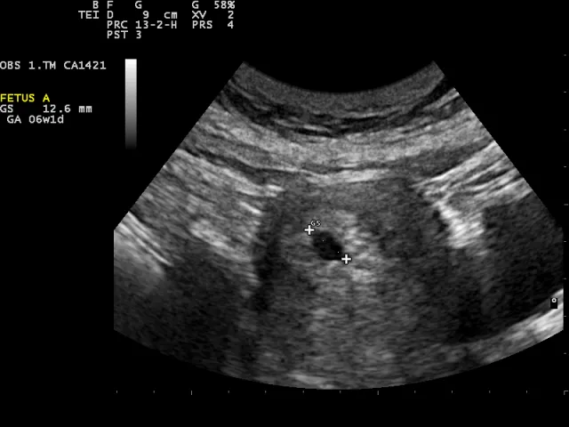 Ecografia 6 semanas de embarazo - La salud de los más Chicos ... Ecografia 6 semanas de embarazo - La salud de los más Chicos ...