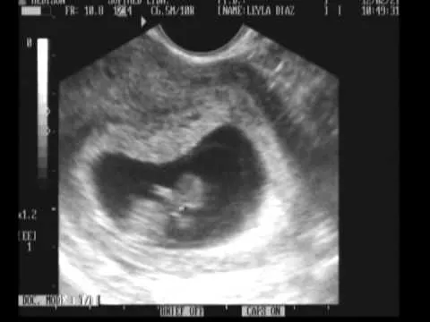 Ecografía 9 semanas de gestación gpardox - YouTube Ecografía 9 semanas de gestación gpardox - YouTube