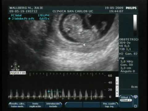 primera ecografia, 9 semanas 5 dias - YouTube primera ecografia, 9 semanas 5 dias - YouTube