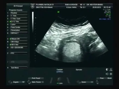 ECOGRAFIA DE 8 SEMANAS Y 4 DIAS - YouTube