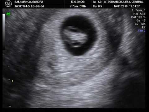 Primera Ecografia 7 Semanas.avi - YouTube