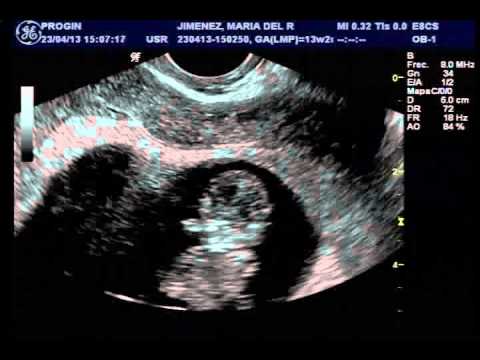 Ecografia transvaginal 10 +5 semanas - YouTube Ecografia transvaginal 10 +5 semanas - YouTube