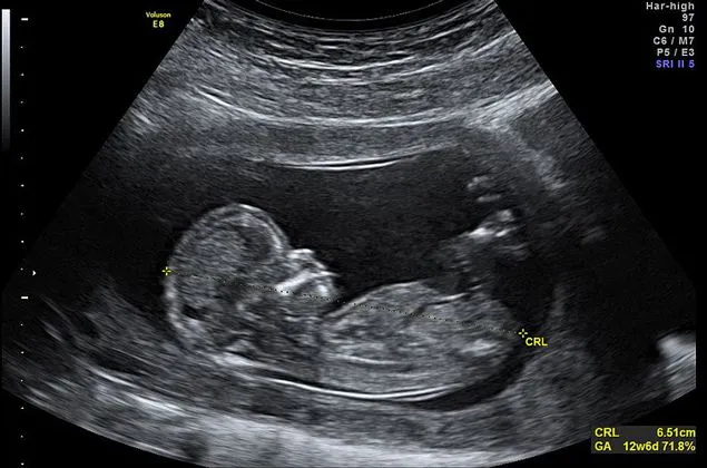 Aborto selectivo de niñas: avanza selección prenatal en función ... Aborto selectivo de niñas: avanza selección prenatal en función ...