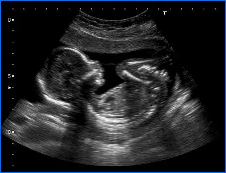 La ecografía, la ventana por la que ves a tu bebé | Embarazo-Online