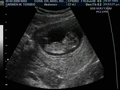 Ecografias 12 semanas de embarazo - Imagui