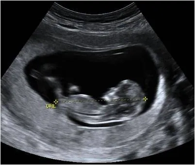 Ecografías durante el embarazo