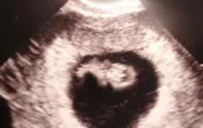  en el embarazo | Sintomas de Embarazo - Informacion embarazo ...