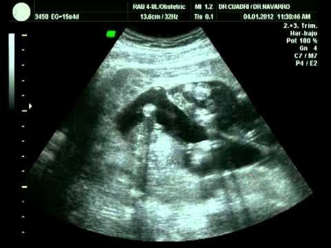 Ecografria de trillizas de 15 semanas - YouTube Ecografria de trillizas de 15 semanas - YouTube