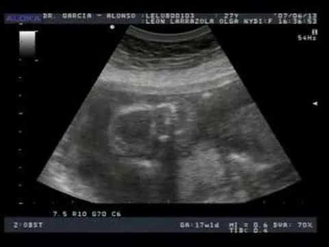 Edgar ??? el bebe de la panza - YouTube