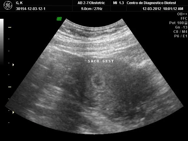 EDSONGCANO: PRUEBA DE EMBARAZO POSITIVA Y ULTRASONIDO NORMAL.