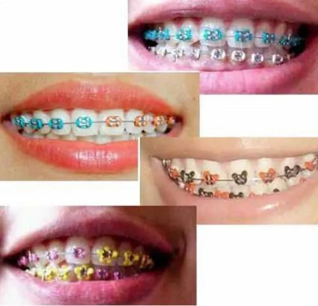 Imagenes de brackets falsos - Imagui