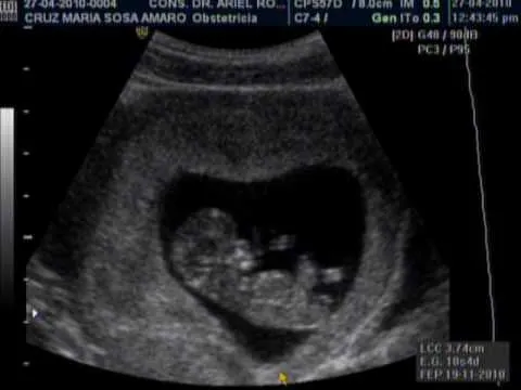 EMBARAZO DE 10 SEMANAS .DR. ARIEL RODRIGUEZ, UNION MEDICA ... EMBARAZO DE 10 SEMANAS .DR. ARIEL RODRIGUEZ, UNION MEDICA ...