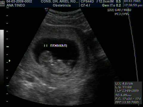 EMBARAZO DE 11 SEMANAS. DR. ARIEL RODRIGUEZ, UNION MEDICA ... EMBARAZO DE 11 SEMANAS. DR. ARIEL RODRIGUEZ, UNION MEDICA ...