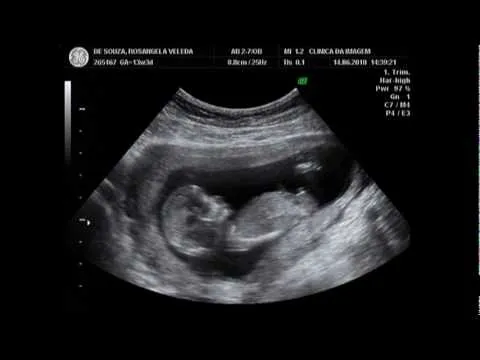 EMBARAZO DE 13 SEMANAS. DR. ARIEL RODRIG - Youtube Downloader mp3