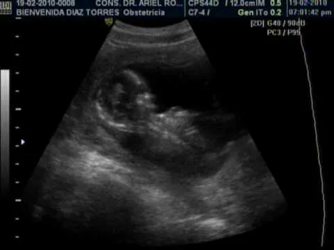 EMBARAZO DE 13 SEMANAS. DR. ARIEL RODRIGUEZ. UNION MEDICA ...