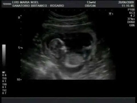 Embarazo. Ecografía 13 semanas y 4 días (¡Es un niño!) - YouTube Embarazo. Ecografía 13 semanas y 4 días (¡Es un niño!) - YouTube