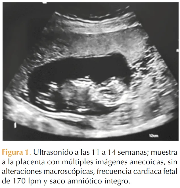 Embarazo gemelar con mola hidatiforme completa y feto vivo coexistente | Revista de Ginecología y Obstetricia de México Embarazo gemelar con mola hidatiforme completa y feto vivo coexistente | Revista de Ginecología y Obstetricia de México