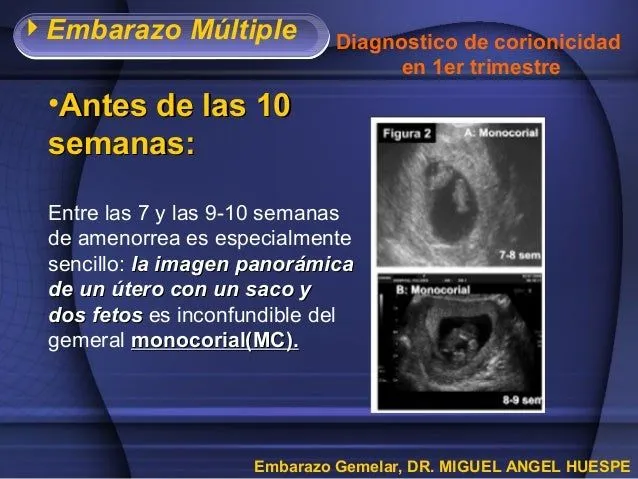 embarazo-gemelar-monocorial-11 ...