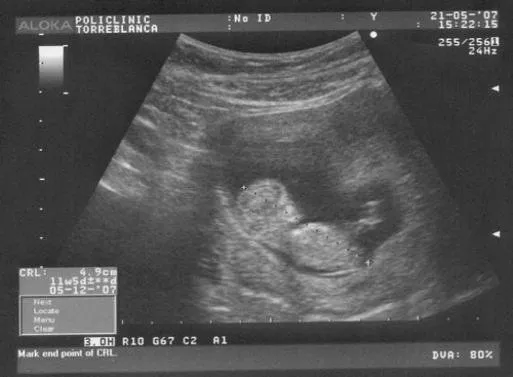 Tu embarazo semana a semana: semana 11 | Tener un bebé es ... Tu embarazo semana a semana: semana 11 | Tener un bebé es ...