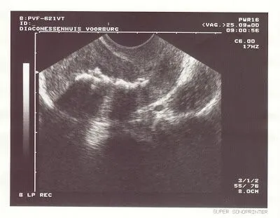 Endoscopia Ginecologica: Retencion Hueso Fetal Intrauterino Endoscopia Ginecologica: Retencion Hueso Fetal Intrauterino
