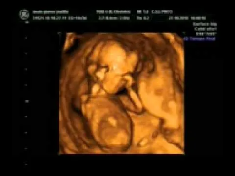 Eco 16 semanas de embarazo - Imagui