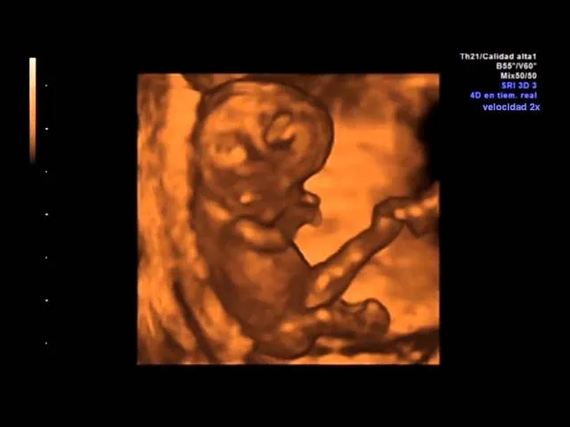 Escuchar Ecografia 7 Semanas - Descargar MP3 Gratis