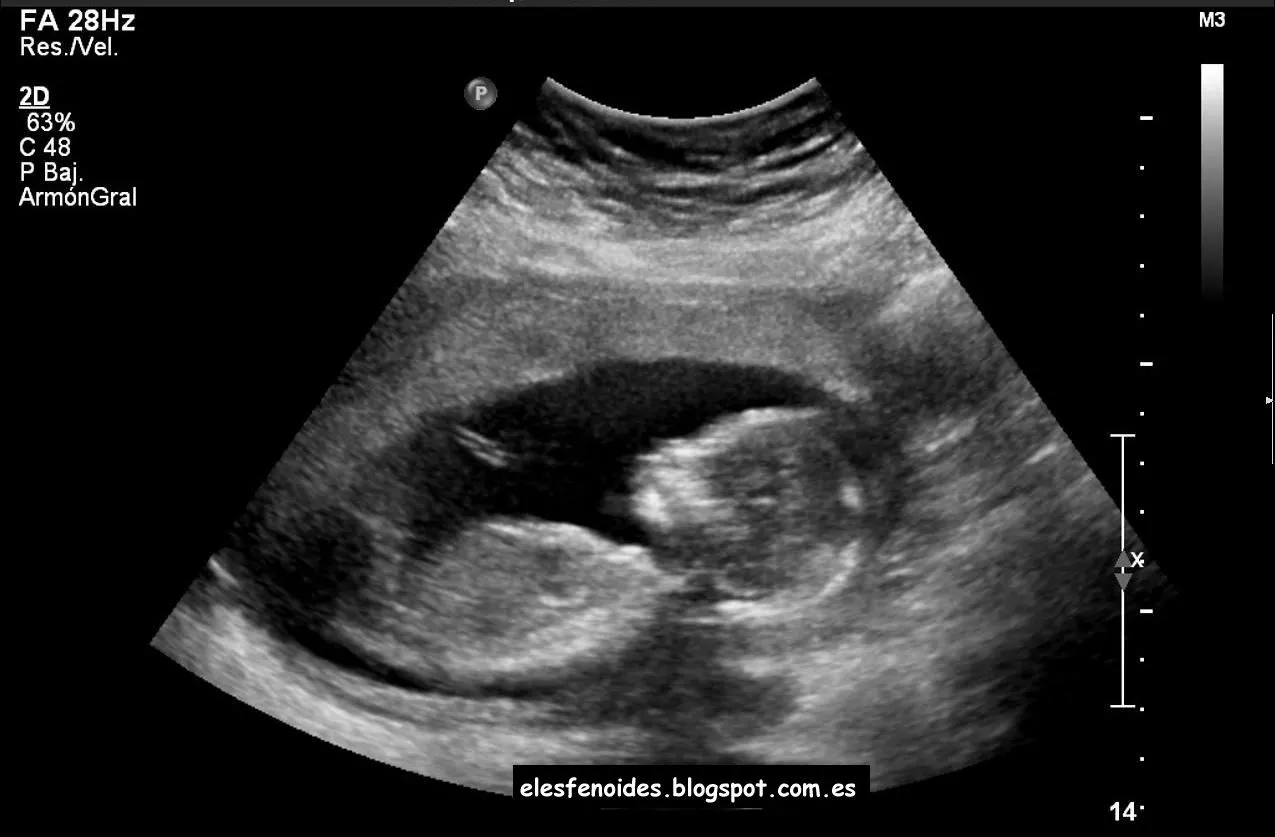 El esfenoides: marzo 2013 El esfenoides: marzo 2013