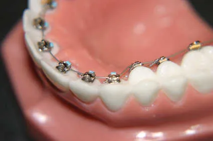 Estética dental y salud: conoce todo sobre la ortodoncia | Línea y ... Estética dental y salud: conoce todo sobre la ortodoncia | Línea y ...