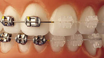 Estética dental y salud: conoce todo sobre la ortodoncia | Línea y ... Estética dental y salud: conoce todo sobre la ortodoncia | Línea y ...