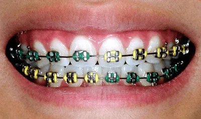 Estética dental y salud: conoce todo sobre la ortodoncia | Línea y ...