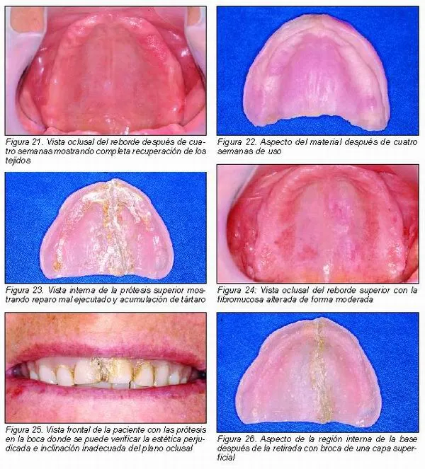 Evaluación clínica de la fibromucosa de revestimiento después del ...