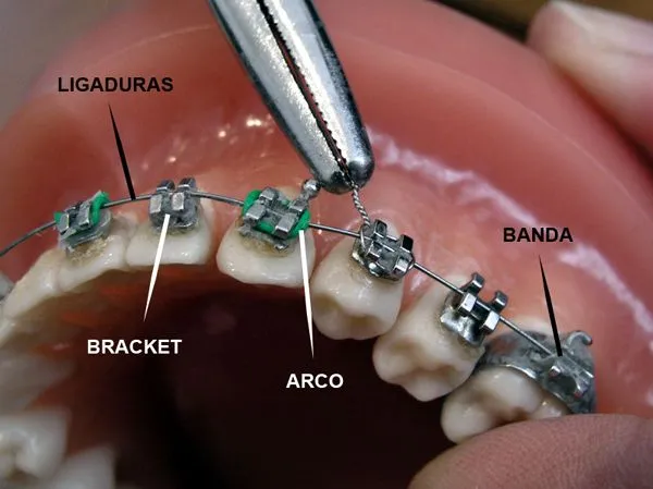 Mi experiencia con Brackets