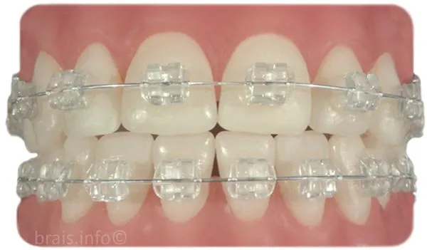 Mi experiencia con los brackets (Actualizable) - Taringa! Mi experiencia con los brackets (Actualizable) - Taringa!