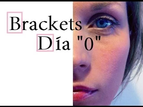 Mi experiencia con los Brackets - Día 0 - YouTube Mi experiencia con los Brackets - Día 0 - YouTube