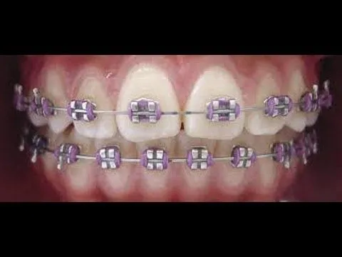 MI EXPERIENCIA CON LOS BRACKETS - YouTube