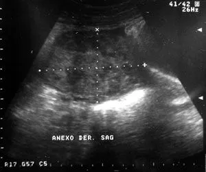 Revista chilena de obstetricia y ginecología - EMBARAZO ECTÓPICO ...